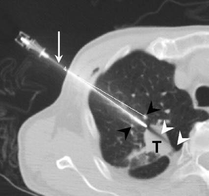 CT-guided lung biopsy