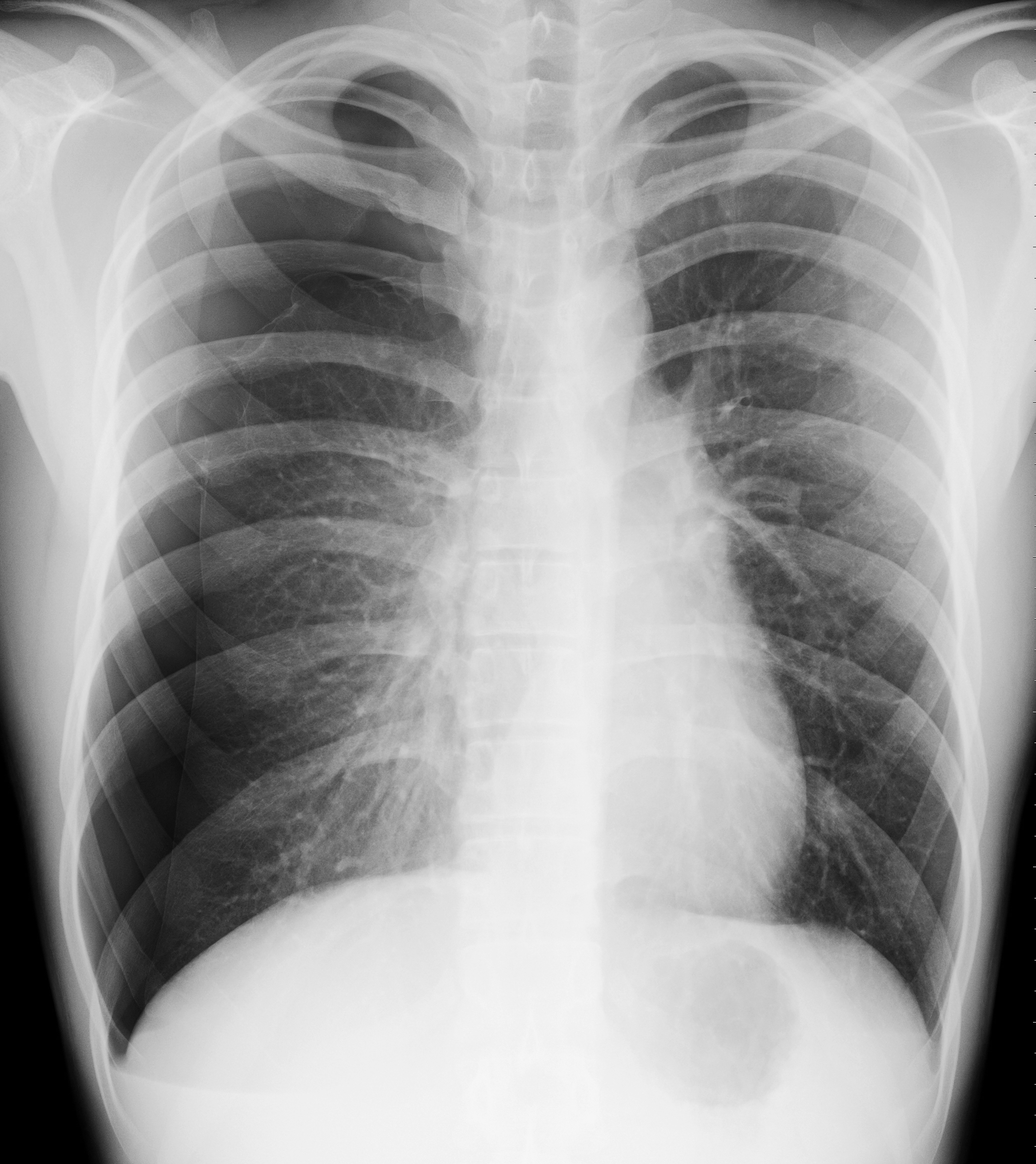 氣胸 X 光片